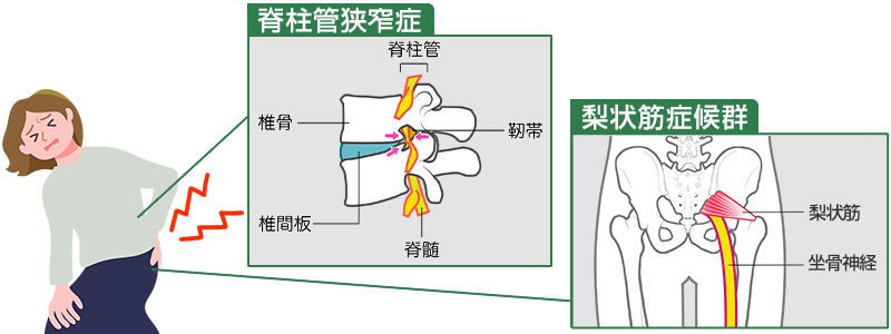 脊柱管狭窄症や梨状筋症候群のイメージ